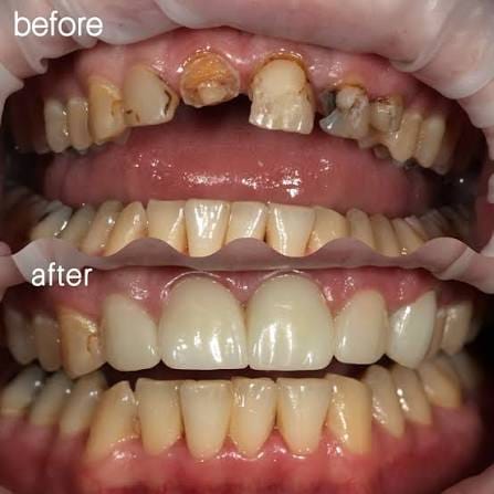 Happy Patient - Orthodontic Treatment Uttam Nagar New Delhi